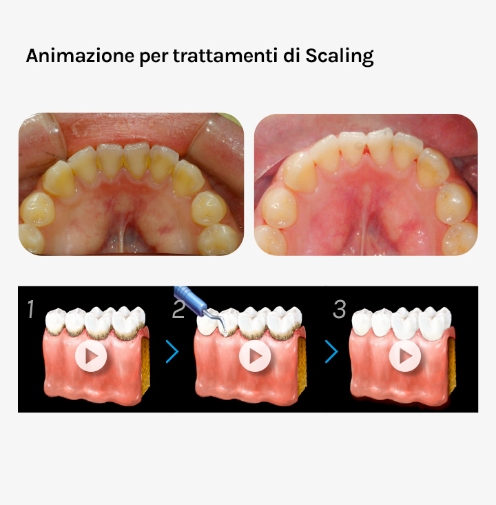 Ez Codi trattamenti di Scaling